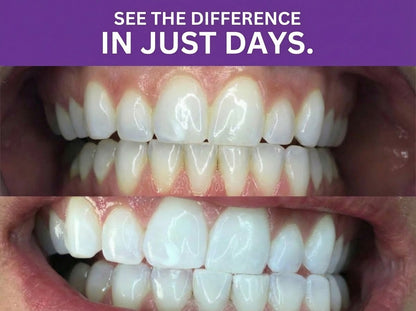 Éleva - PAP + Whitening Strips